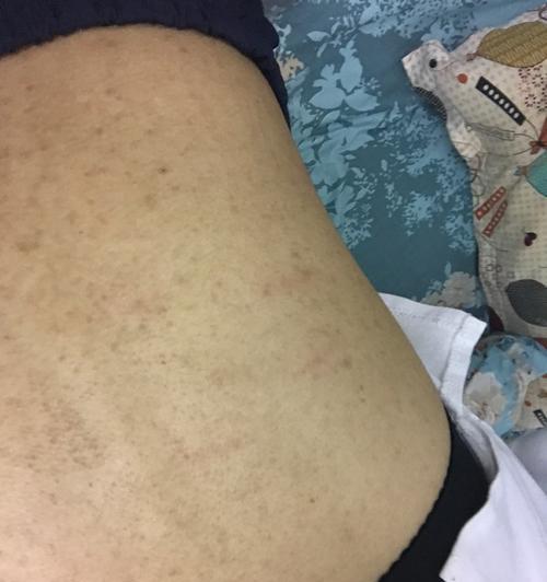 苹果手机后背出现黑点是怎么回事？