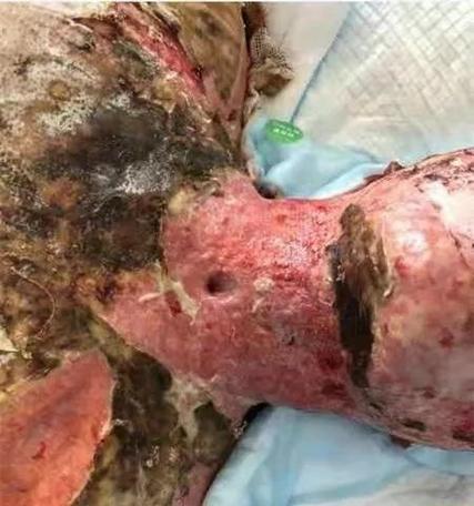 筠连电视机为何会爆炸？可能的原因有哪些？